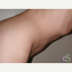 41 year old woman treated with Tummy Tuck after 3484829