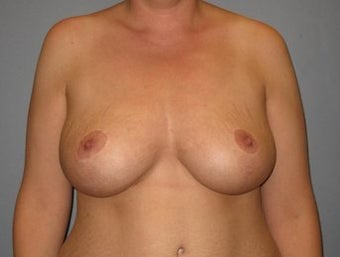 37 Year Old Breast Reduction Patient after 1355934