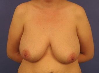 37 Year Old Breast Reduction Patient before 1355934