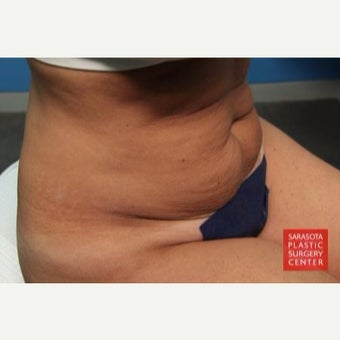 41 year old Sarasota mother of 3 had Mini Tummy Tuck and Liposuction before 2389528