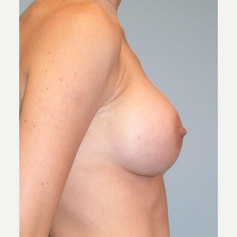 33 year old mother of 4. Silicone breast augmentation. 375 cc high profile. A to small C after 3292115