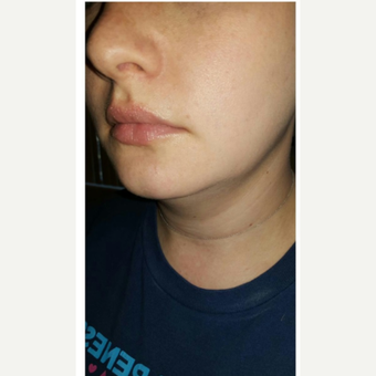 25-34 year old woman treated with Kybella before 2995081