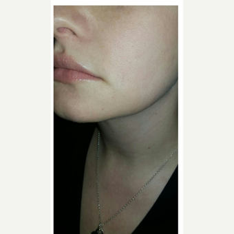 25-34 year old woman treated with Kybella after 2995081