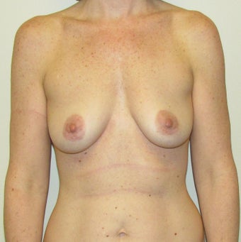 39 Year Old Female Gummy Bear Sientra Breast Implants before 1349084