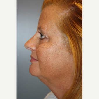 45-54 year old woman treated with Fraxel Laser before 3708655