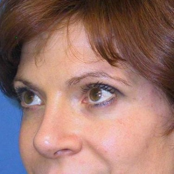 25-34 year old woman treated with Rhinoplasty after 3497243