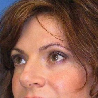 25-34 year old woman treated with Rhinoplasty before 3497243