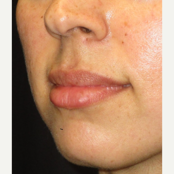 25-34 year old woman treated with Juvederm after 3153635
