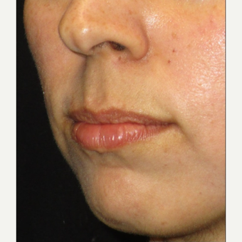 25-34 year old woman treated with Juvederm before 3153635
