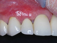 Gum Graft after 515422