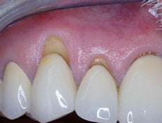 Gum Graft before 515422