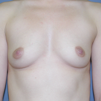 34 year old woman treated with Breast Augmentation before 3042637