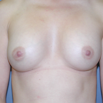 34 year old woman treated with Breast Augmentation after 3042637