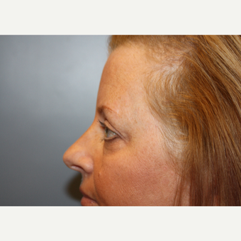 45-54 year old woman treated with Eyelid Surgery after 3708630