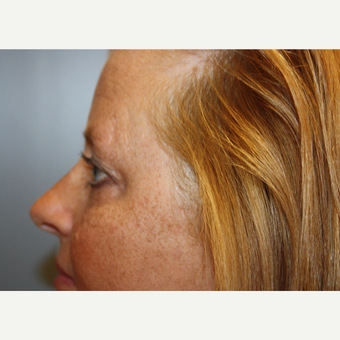 45-54 year old woman treated with Eyelid Surgery before 3708630