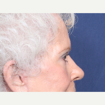 75 and up year old woman treated with Eyelid Surgery (view 2 of 2) after 3181078