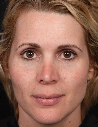 Non-Laser Resurfacing for Tone and Texture before 1357168