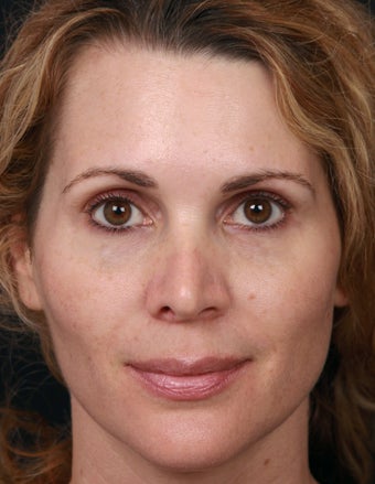 Non-Laser Resurfacing for Tone and Texture after 1357168