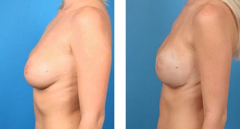 28 Year Old Woman, Cassileth One-Stage Breast Reconstruction after 1039937