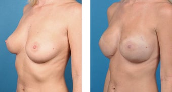28 Year Old Woman, Cassileth One-Stage Breast Reconstruction 1039937