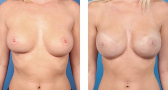 28 Year Old Woman, Cassileth One-Stage Breast Reconstruction before 1039937