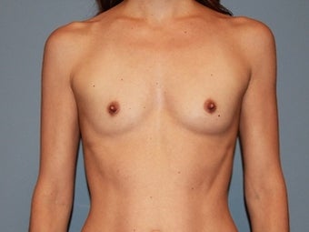 41 year old patient receives breast augmentation with form stable (gummy bear) implants before 1325439