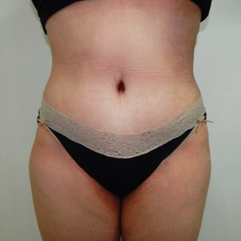 35-44 year old woman treated with Tummy Tuck after 3723964