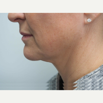 45-54 year old woman treated with Non Surgical Face Lift before 3679635