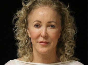 65-74 year old woman treated with Facelift, quad blepharoplasty 2509133