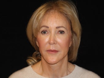 65-74 year old woman treated with Facelift, quad blepharoplasty 2509133