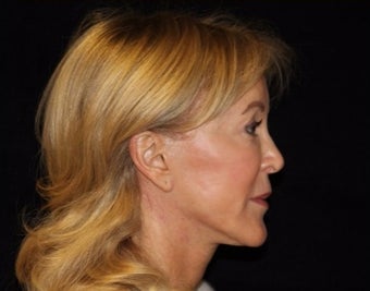 65-74 year old woman treated with Facelift, quad blepharoplasty after 2509133