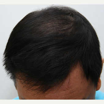25-34 year old man treated with ARTAS Robotic Hair Transplant after 3697148