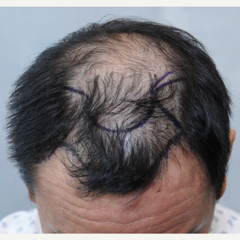 25-34 year old man treated with ARTAS Robotic Hair Transplant before 3697148