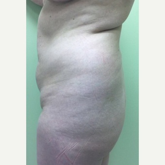 35-44 year old woman treated with Brazilian Butt Lift before 3039510