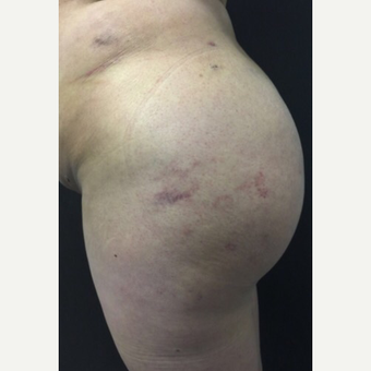 35-44 year old woman treated with Brazilian Butt Lift after 3039510