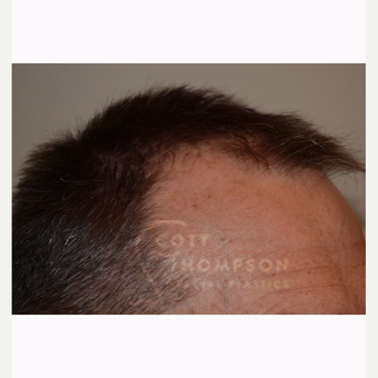 45-54 year old man treated with Hair Transplant before 3430284