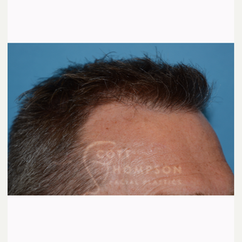 45-54 year old man treated with Hair Transplant after 3430284