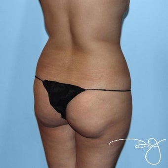 Butt Augmentation 1069985