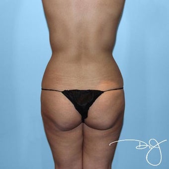 Butt Augmentation before 1069985