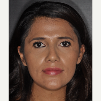 25-34 year old woman treated with Septoplasty 10 days post-op after 3452262