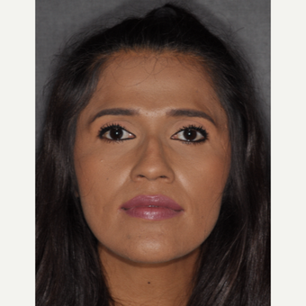 25-34 year old woman treated with Septoplasty 10 days post-op before 3452262