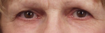 CO2 to lower lids after 273328