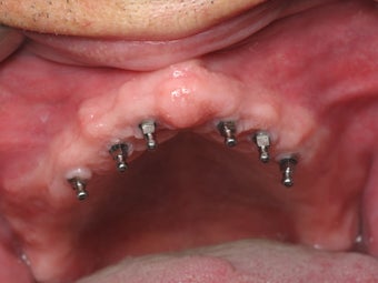 Mini dental implants help stabilize loose dentures 1168520