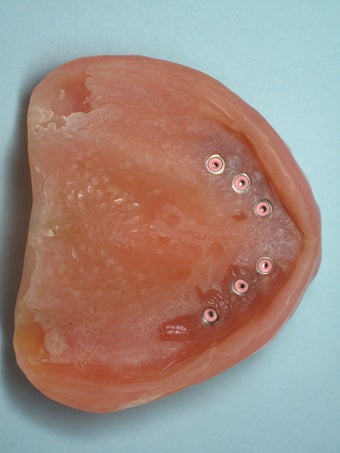 Mini dental implants help stabilize loose dentures 1168520