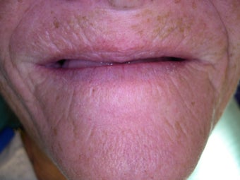 Mini dental implants help stabilize loose dentures before 1168520