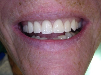 Mini dental implants help stabilize loose dentures after 1168520