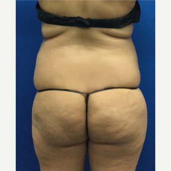 35-44 year old woman treated with Brazilian Butt Lift before 3697572