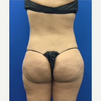 35-44 year old woman treated with Brazilian Butt Lift after 3697572
