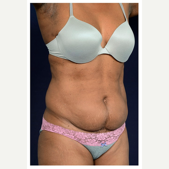 45-54 year old woman treated with Tummy Tuck before 3076172