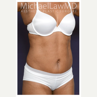 45-54 year old woman treated with Tummy Tuck after 3076172